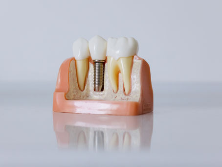 "Missing a Tooth? No Problem! 4 Easy Ways to Restore Your Smile"