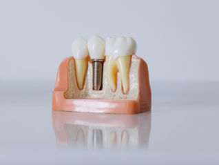 "Missing a Tooth? No Problem! 4 Easy Ways to Restore Your Smile"