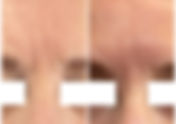 Botox Services